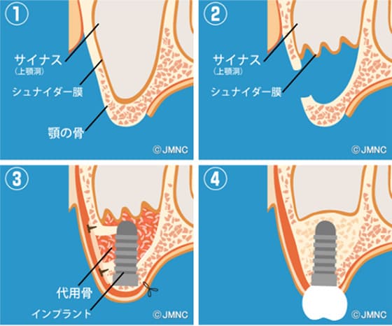 All-on-4 とは？の図解